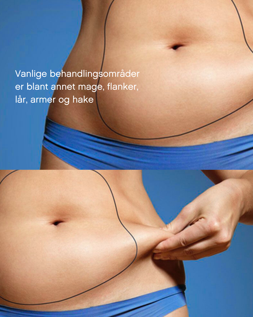 Coolsculpting